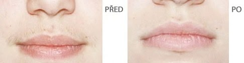 Výsledek IPL depilace – před a po ošetření horního rtu